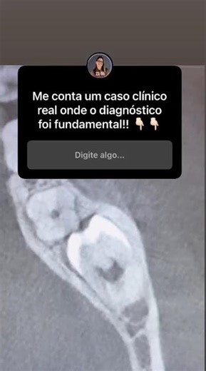 Terceiro Molar e Canal Mandibular: A importância da Tomografia Cone Beam (TCCB)