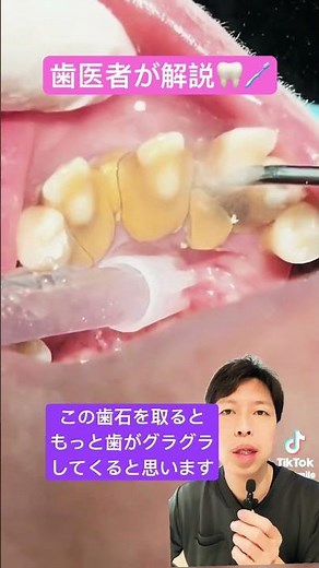 Fixing loose teeth with tartar 🦷 #tartarremoval #tartar #periodontaldisease #severe #wobbly #mobi...