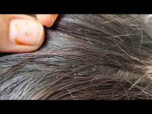 “Extreme nits Eggs Cleaning 🪳 | ASMR Satisfying Video”