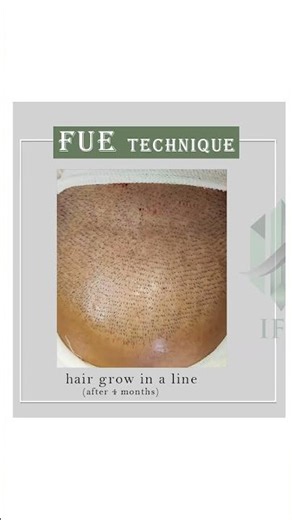 IFT Vs FUE Technique Difference? Hair Transplant in Delhi | IFT Hair Science