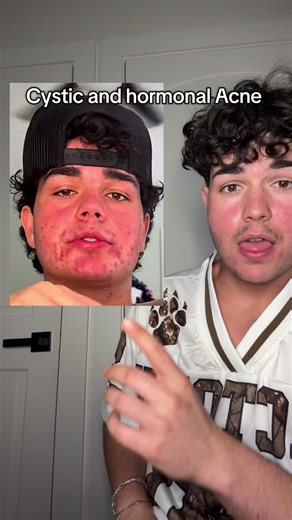 This is the only thing that has worked #acnetreatment #acne #acneproneskin #acneskincare