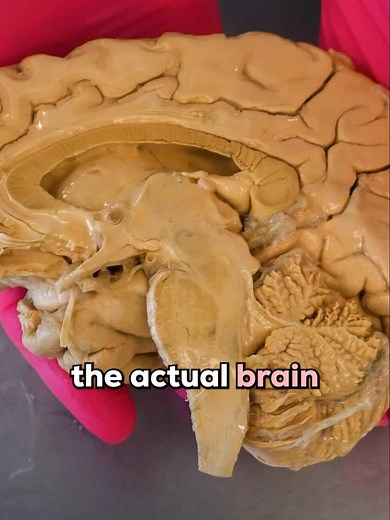 Glioblastoma is one of the most aggressive brain tumors known to medicine — and the biology behind why makes it especially devastating. 🧠 Neurons and mature muscle fibers don't typically divide, which is why they rarely form tumors. But glial cells do divide — and when they accumulate enough DNA mutations, that division can spiral out of control. The result is a glioblastoma, most commonly arising from astrocytes. Unlike meningiomas that grow on the outside of the brain and compress inward, gli