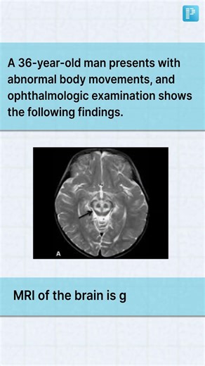 MRI Brain Case on Abnormal Movements for NEET PG