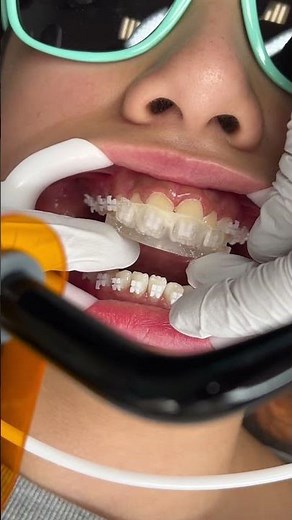 How Braces are Put On