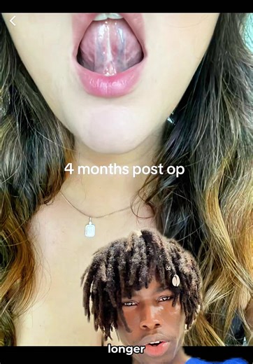 How to Treat Your Tongue Tie #glowup #tonguetie #teeth | tongue tie vs normal