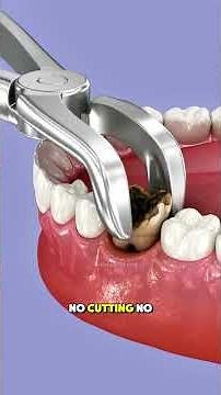 How Tooth extraction procedure is performed?