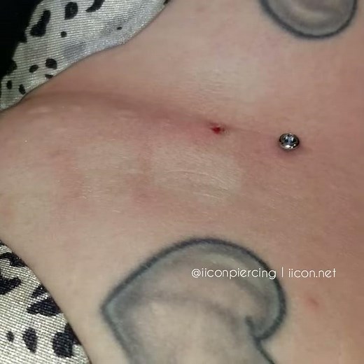Dermal anchor removal