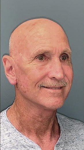 1 month post op male face and neck lift