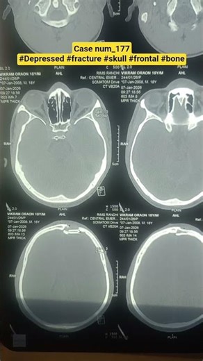 case num_177 #Depressed #fracture #skull #frontal #bone #Drsourabhneurosurgeon