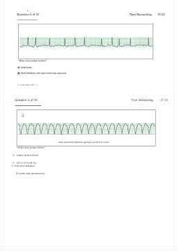 Latest 2025 2026 Relias Dysrhythmia Basic Test 35 Exam Questions With 100 Correct Answers