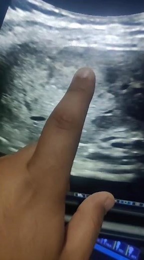 Ultrasound “Target Sign” in Metastatic Lesions | Recognizing Typical Features