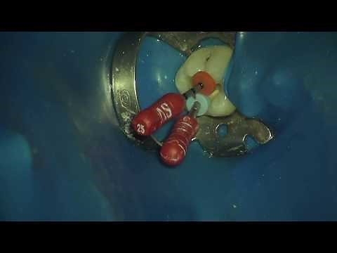 GuttaCore Obturation Step-by-Step Video