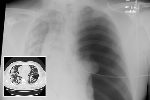 Shocking x-ray shows Covid patient's collapsed lung after coughing for 3 weeks