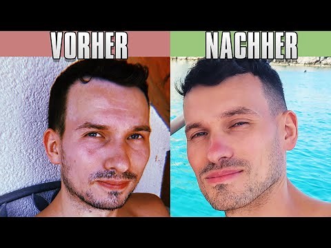 3 Jahre nach BIMAX OP mit Vorher Nachher Bildern - Erfahrungsbericht