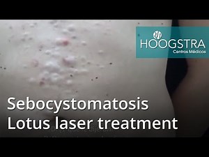 Sebocystomatosis - Lotus laser treatment (20221)