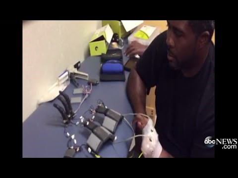 Prosthetic Allows Amputee to Move 'Fingers'