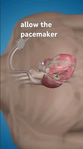 How heart pacemaker works?#pacemaker #Heartproblems#3Danimation#3Dmedicalanimation