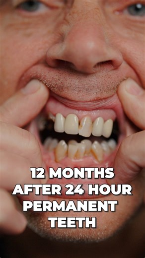 12 months with Nuvia Dental Implants... Was it worth it?? 🫢🦷 #nuviateeth #dentalimplantscost #dentures #nuvia #SmileTransformation | Nuvia Dental Implant Center