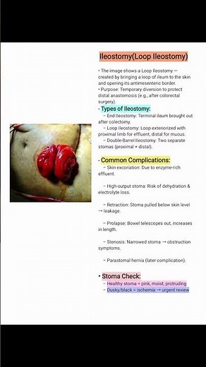 Ileostomy Types & complications#medicaleducation#exampreparation#shortsfeeds#General Surgery Toacs