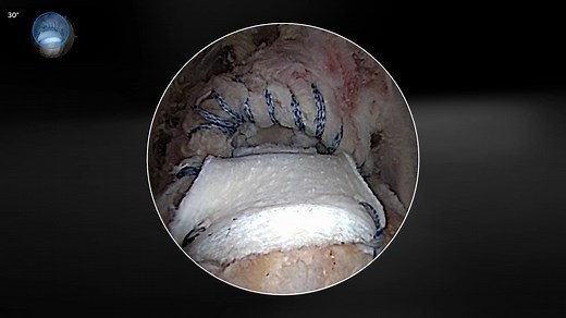 Posterosuperior Rotator Cuff Tears: Rotator Cable Reconstruction With Biologic Tuberoplasty