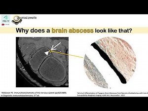 Brain abscess vs glioblastoma - dual rim sign on MRI