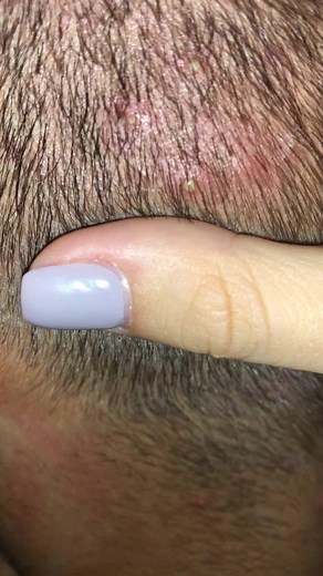 Я которая обожаю давить, он которому больно #выдавливаниепрыщей #выдавливаниечерныхточек #черныеточки #прыщики #нос #голова