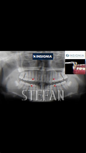 we got segmental LF1 at home! alveolar process reshaping is life changing and it’s not talked about much #orthodontics #looks #bp
