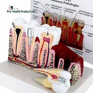 [Hot Item] Dental Study Plastic Periodontal Teeth Human Medical Decay Common Pathologies Teeth Model