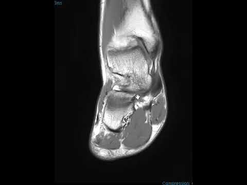 Spring ligament tear