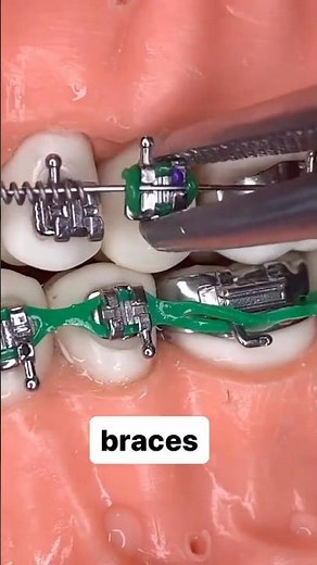 Braces installation , Orthodontics #braces #dentist #orthodontist #smiledesigndental