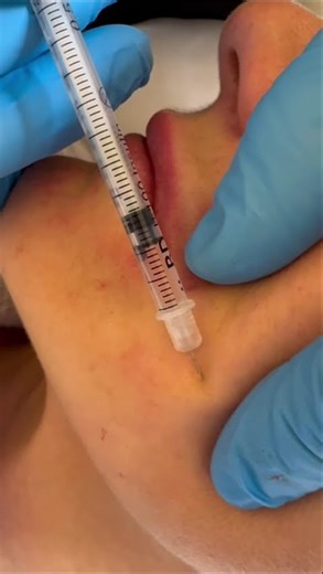 Micro-injections for superficial wrinkles using a low G′ filler