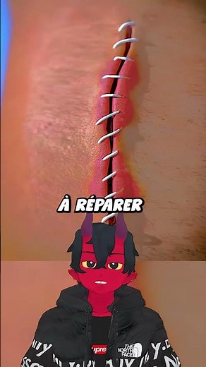 Comment Fonctionnent Les Points De Suture