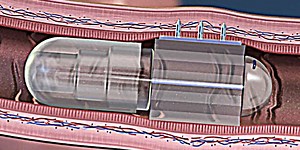 Shot to the Gut: “Robotic” Pill Sails Through Human Safety Study