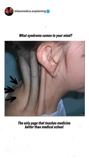 Medical ⚕️ on Instagram: "Options: A) Congenital torticollis B) Pterygium colli (Webbed neck) C) Thyroglossal duct cyst D) Short neck . Follow if you want to become a good doctor ‍⚕️‍⚕️良 . Dm for credit or removal . #viral #reel #doctor #biology #medicalstudent #education #exploer #student #study #study #mcqs #quiz #information #instagram"