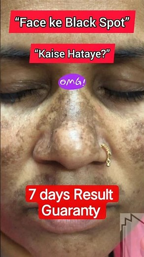 How to remove black spots on the face | Easy remedy for blemishes 😱