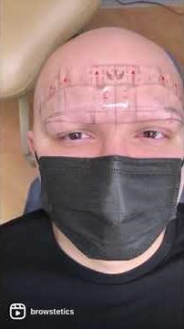 Male Eyebrow Microblading with Alopecia