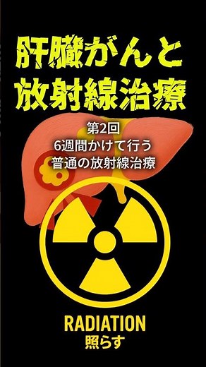 【肝臓がんと放射線治療②】 「6週間かけて行う普通の放射線治療」 #肝臓がん #肝細胞癌 #放射線治療 #緩和医療 #がん治療 #健康情報 #shorts