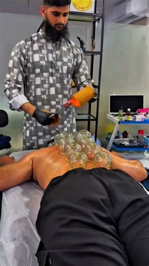 Fire Cupping #hijama#cuppingtherapy#asmr#asmrsounds#asmrvideo#sports#cupcure#therapy#session
