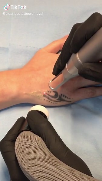 Tattoo Removal Sessions: Progress and Results