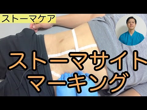 [Stoma care] How to mark the stoma site before colostomy