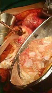 case of hydatid cyst of liver