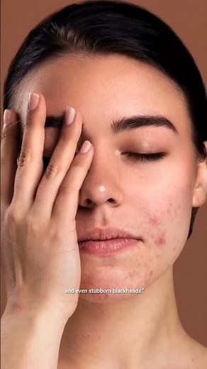 Epiduo Gel Review 🔥 Acne Gone? Real Results in 7 Days!