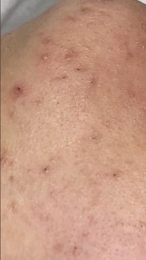 Deep jawline acne — smooth and relaxing removal 😌💆‍♀️#shortvideo #skincare #acne #blackheads