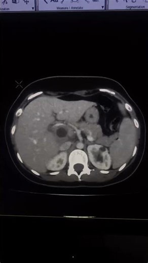 Cholecystitis and Gallbladder Health