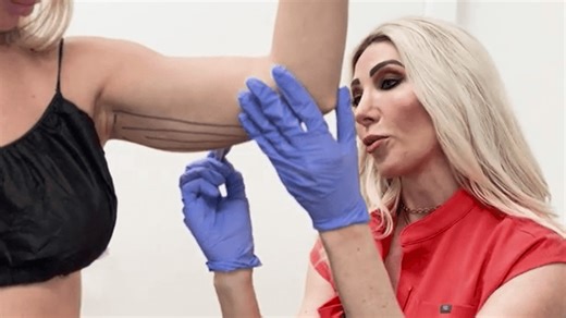 Liposuction while awake: the pros and cons of the trendy procedure