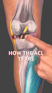 123K views · 2.5K reactions | Knee caved in during a cut or landing?...