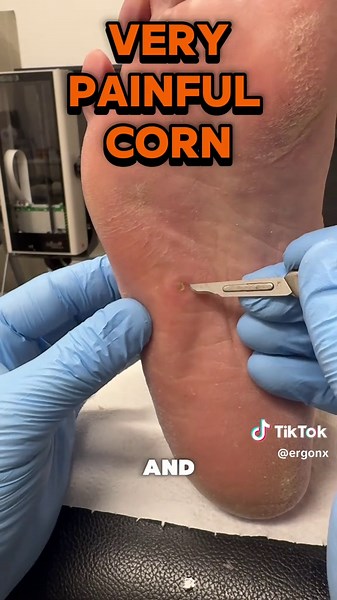 Very painful deep corn removal in the podiatry clinic ergonx.com.au #callus #corn #podiatrist #australia #satisfying #ergonx #footpain