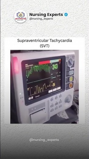 Supraventricular Tachycardia (SVT) Explained | Vagal Maneuver Demonstration