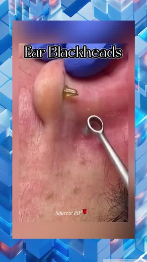 squeezeuk acne pimple popping viral abscess satisfying (362)