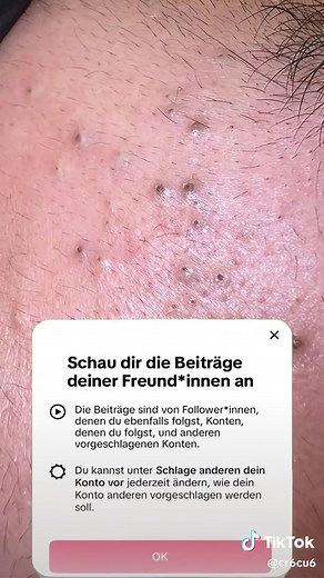 #pimple #pop #satisfying (1346)